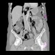 Pneumomediastinum, pneumoretroperitoneum, perforation of sigmoid colon, complication of colonoscopy: CT - Computed tomography